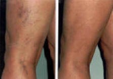 typisk misfarging av hud - før og etter